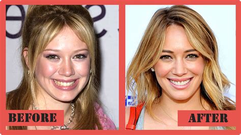 hillary duff nose job|Viral Hilary Duff Photo Has People Questioning If It’s Real